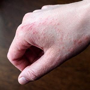 Rash on hands – Artofit