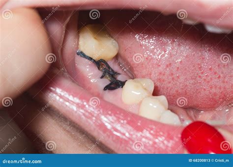 stitches  dental extraction royalty  stock photo
