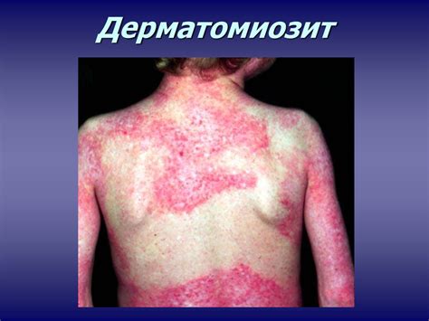 Системные заболевания кожи: склеродермия, дерматомиозит, склерема и ...