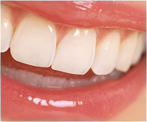 New Artificial Tooth Structure Shows Its Strength