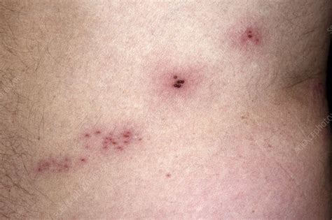 Healing shingles rash - Stock Image - C047/8496 - Science Photo Library