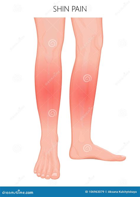 Bone fracture_Shin pain-09 stock vector. Illustration of human - 106963079