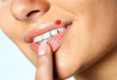 Герпес: лечение, препараты нового поколения | MedAboutMe