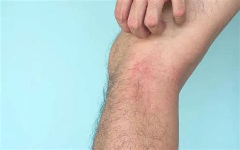 Inverse Psoriasis | Symptoms, Causes, Treatment, Prevention – Barphani