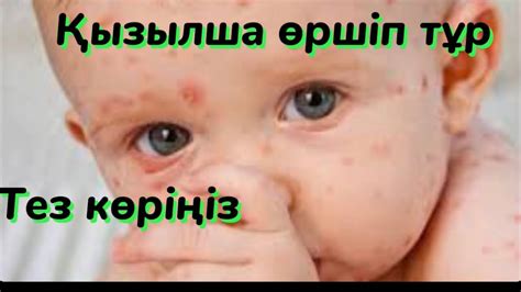 Қызылша ауруы қауіпті, инфекция-корь - YouTube
