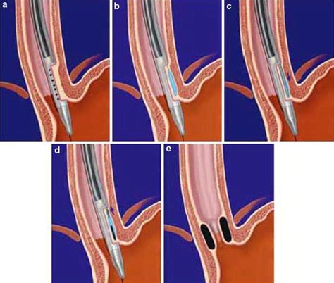 Gatekeeper procedure. a The esophageal wall is aspirated. b Normal ...