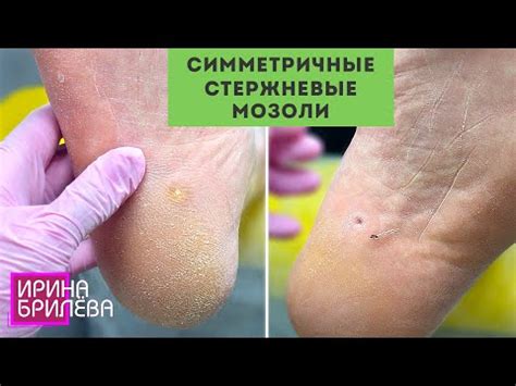 СИММЕТРИЧНЫЕ стержневые мозоли 🌸 Что бывает, если НЕ ВОВРЕМЯ снять ...