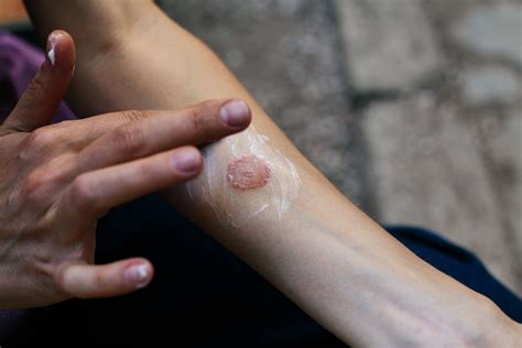 Fungal Infections Treatments | DermDox Dermatology