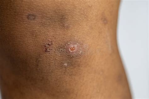 Atopic Dermatitis and Fungal Diseases on the Human Body. Stock Image ...