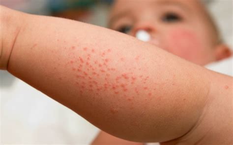 Types Of Baby Rashes Baby Rash Body Rash Newborn Rash - vrogue.co