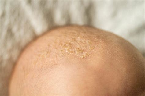 Seborrhoeic dermatitis - Dr Piotr Turkowski