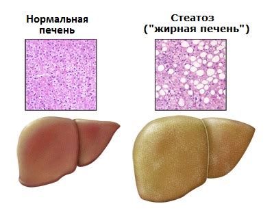 Cтеатоз печени – симптомы, лечение
