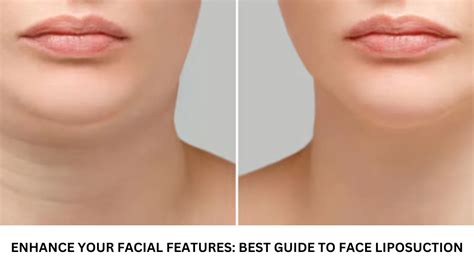 Best Guide to Face Liposuction: Enhance Your Facial Features