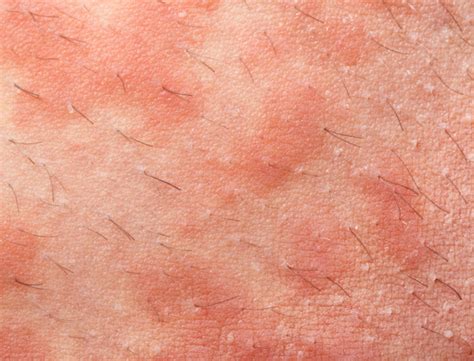 Lamictal Skin Rash May Be an Early Sign of Something Worse