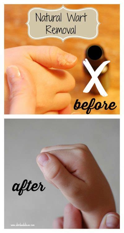Natural, Effective Wart Removal