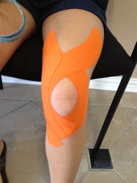 Patellofemoral Pain Syndrome Taping Kinesio Taping – Dr. Soroush