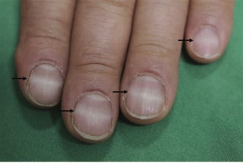 Nail Abnormalities at High Altitude | High Altitude Health