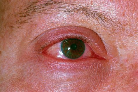 Acute Allergic Conjunctivitis Photograph by Dr P. Marazzi/science Photo ...