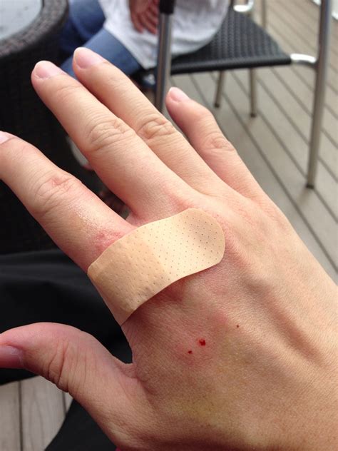 What Should You Do After A Dog Bite