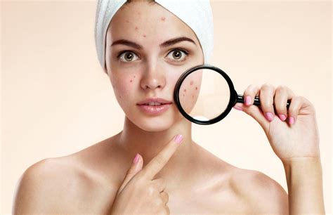 Акне - причины и лечение | Kosmetologiya-dermatologiya.az