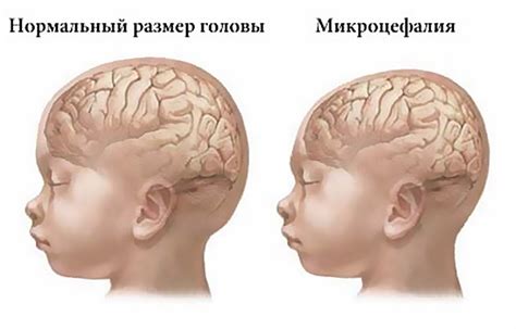 Микроцефалия : причины, симптомы, методы лечения микроцефалии