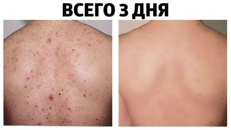 Как избавиться от прыщей на спине?