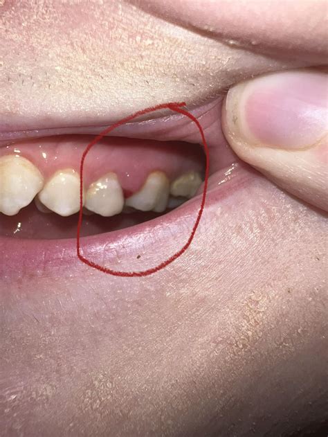 infected tooth bleeding daily raskdentists