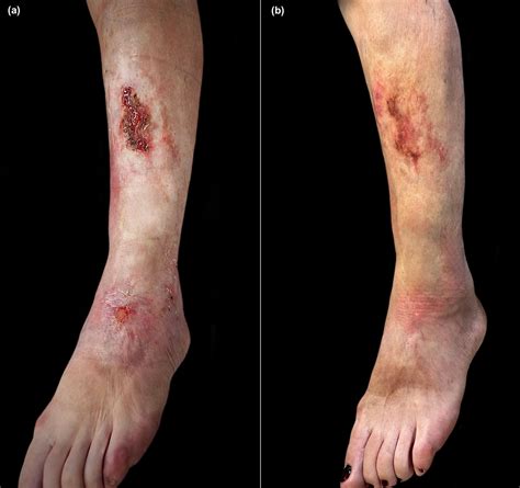 Upadacinib for the Treatment of Refractory Morphea - Maione - 2025