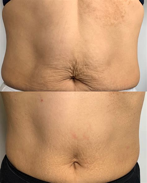 skin tightening radio frequency treatment  toronto