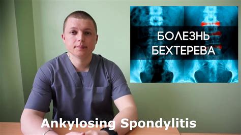 Болезнь Бехтерева | Bekhterev's disease | Остеохондроз | Ревматоидный ...