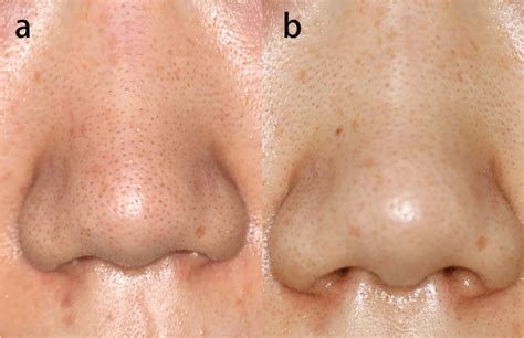 A Photo of a patient with enlarged facial pores; b 2 months after one ...