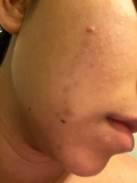 postpartum skin help! hormonal acne I think?? : r/Skincare_Addiction