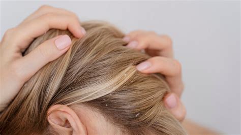 Scalp Psoriasis Hair Loss: Causes, Treatment, And Prevention | OnlyMyHealth