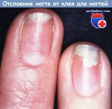Отслоение ногтевой пластинки при болезнях