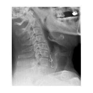Swallowed Denture, X-ray Photograph by Du Cane Medical Imaging Ltd ...