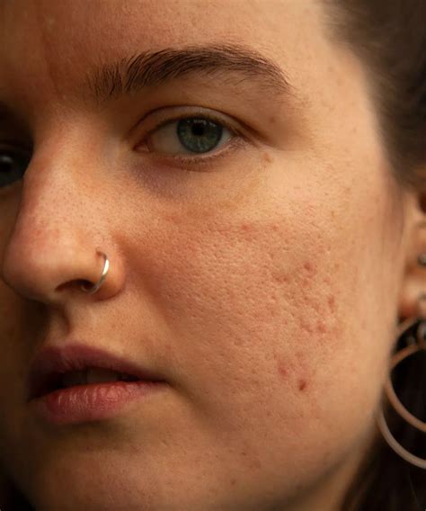 From Acne To Pigmentation, Here Are The Best Lasers For Every Skin