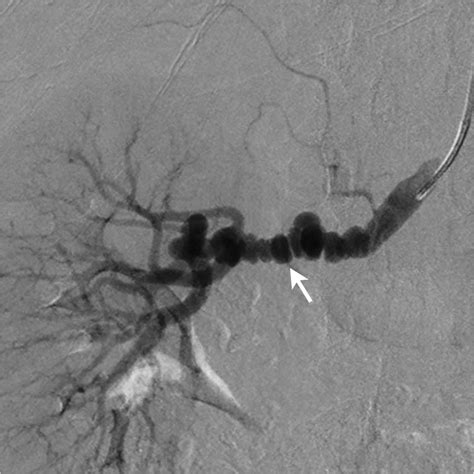 Renal fibromuscular dysplasia | BMJ Case Reports
