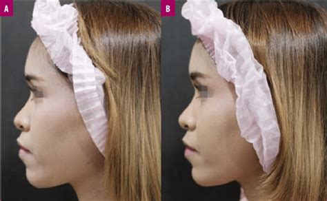 Photographs comparing the results in one participant A) before ...