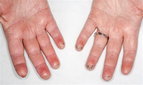 Calloused, Hyperpigmented Fingertips | NEJM