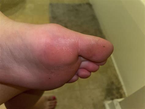 are these little warts on my feet or do I just have dry feet/callus? i