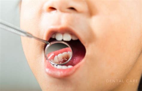 Cuidados importantes para los dientes de leche | Dental Care Barcelona
