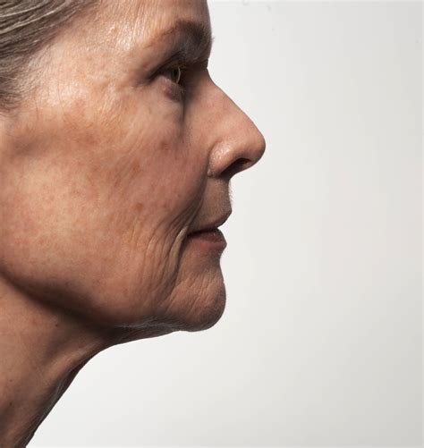 What is Pustular Psoriasis?