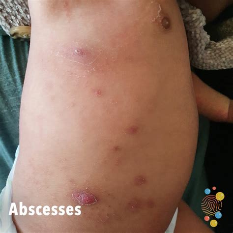 skin abscess drainage vrogueco