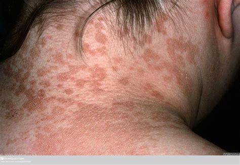 pityriasis versicolor tinea versicolor - pictures, photos