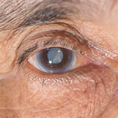 Does Medicare Cover Eye Surgery? - Medicare Plan Tips