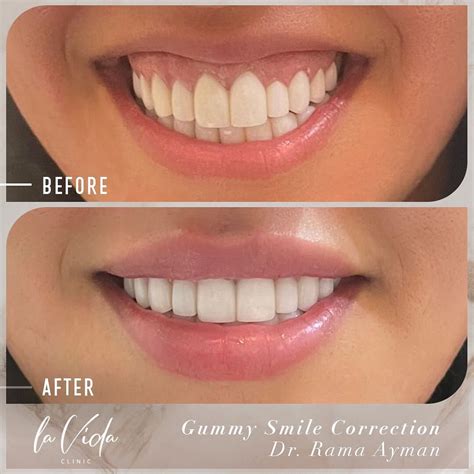 Gummy Smile Archives - La Vida Clinic