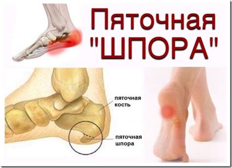 Пяточная шпора: симптомы и лечение в домашних условиях