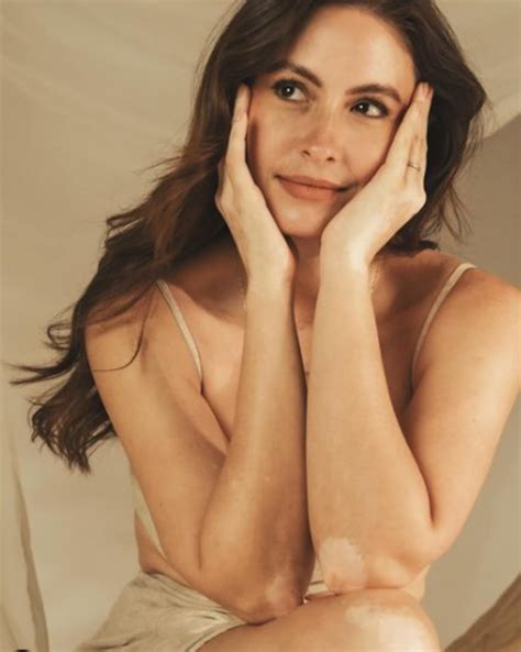 Taliana Vargas se refirió a su vitiligo y mostró las manchas que tiene