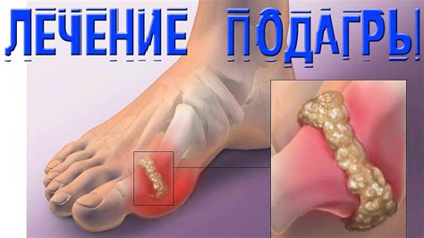 Как вылечить подагру и артрит народными методами - YouTube