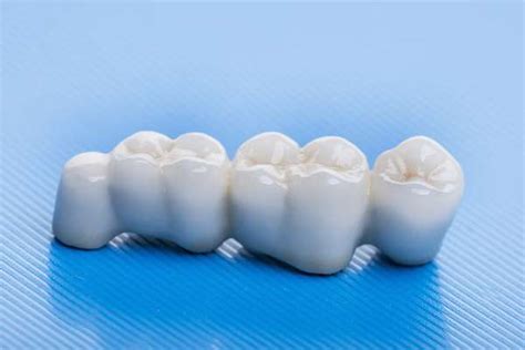 teeth  dental bridges replace
